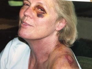frightening first months of what was to be a five-year recovery